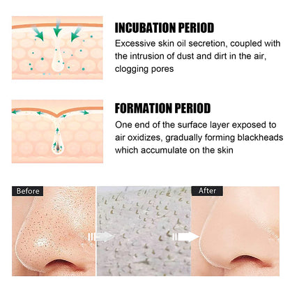 Blackhead Remover Tools -15g Blackhead Creamwith 40Pcs Blackhead Pore Strips